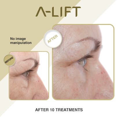 A‑Lift results example 3