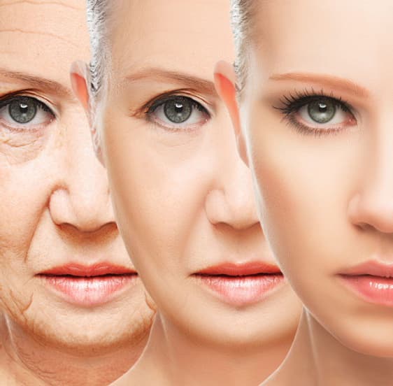 A‑Lift results example 1